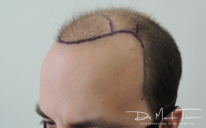Image of Alex's treatment