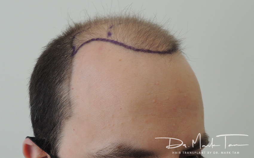 Image of Alex after the treatment